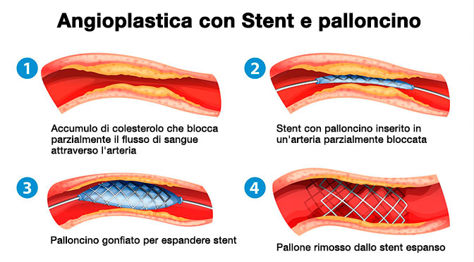 Lo stent coronarico è un cilindro metallico che, in combinazione con un palloncino, è utilizzato per riaprire le arterie ostruite da depositi a placche aterosclerotiche. La procedura di angioplastica permette di raggiungere il vaso ostruito a partire da una piccola incisione nel braccio (arteria radiale) o nella gamba (arteria femorale), tramite la quale si inserisce un catetere munito all’estremità di un piccolo palloncino e si completa con l’applicazione dello “stent”. Gli stent sono impiegati soprattutto nei trattamenti di rivascolarizzazione delle arterie.