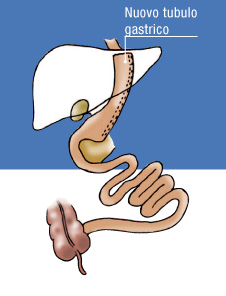 sleeve gastrectomy