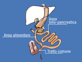 sleeve gastrectomy