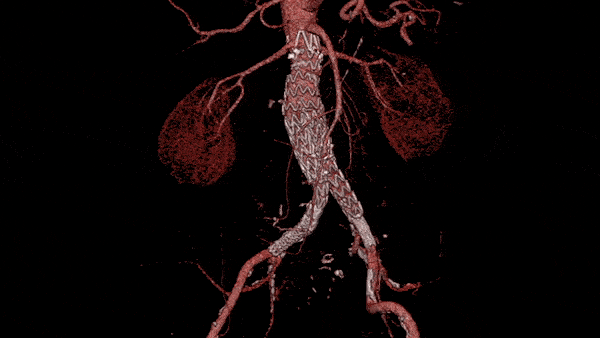 L’aneurisma aortico può essere corretto con un intervento chirurgico tradizionale (resezione e sostituzione dell’aorta malata con una protesi) o con un trattamento endovascolare (EVAR /TEVAR) che consiste nell'escludere la sacca aneurismatica dal flusso ematico posizionando al suo interno una endoprotesi. EVAR e TEVAR evitano l’apertura del torace o dell’addome e possono essere eseguiti in anestesia locale.